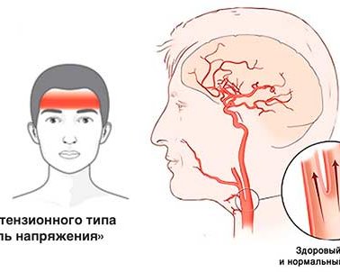 Головная боль напряжения