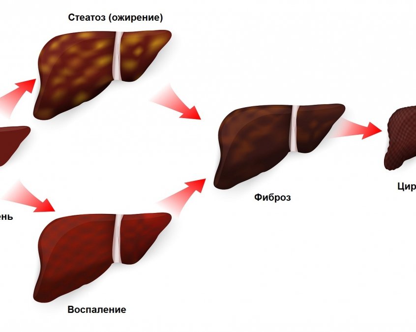 УЗИ печени