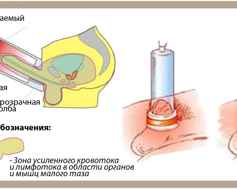 ЛОД-терапия