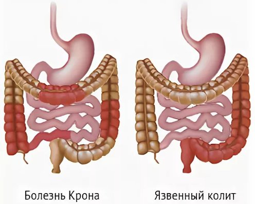 Воспалительные заболевания кишечника