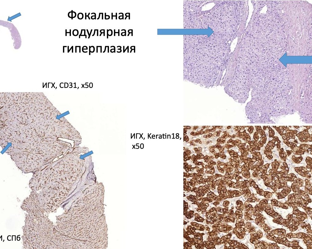 Фокальная нодулярная гиперплазия