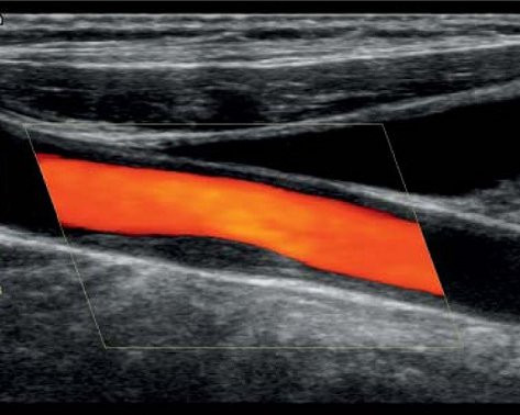 УЗИ сосудов верхних и нижних конечностей